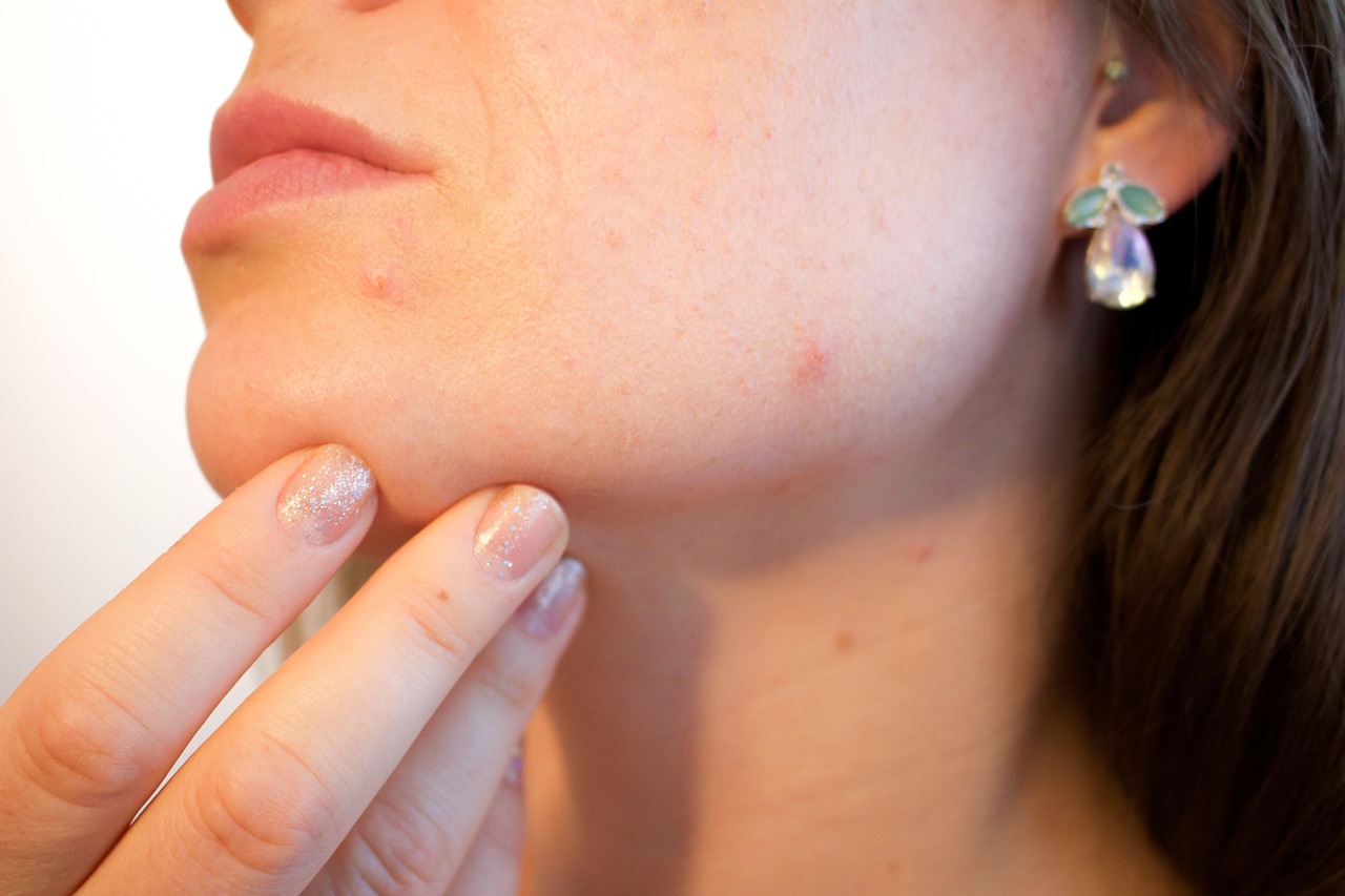 Acne, pores, skin — illustrating GLP-1s and the Gut Microbiome
