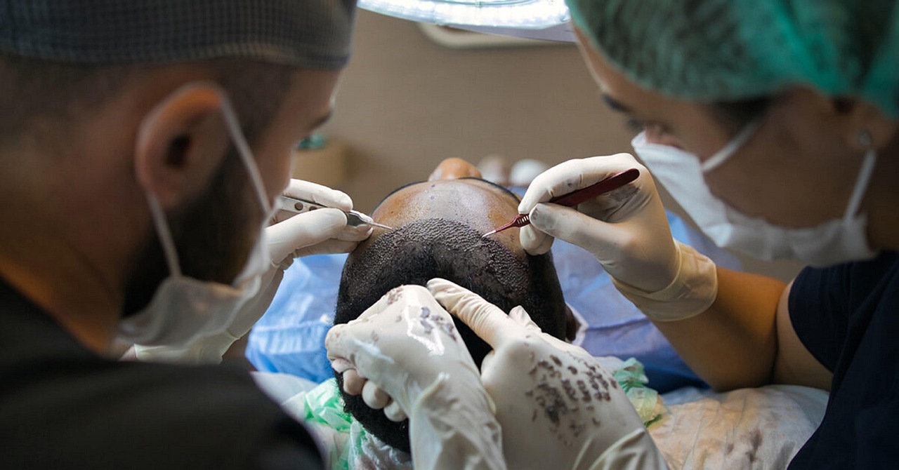 Hair transplant, treatment, surgery — illustrating Melanotan II: Why the Tanning Peptide Carries Real Risks